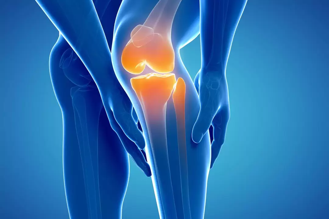 Osteoarthritis of the knee joint (gonarthrosis, deforming osteoarthritis)