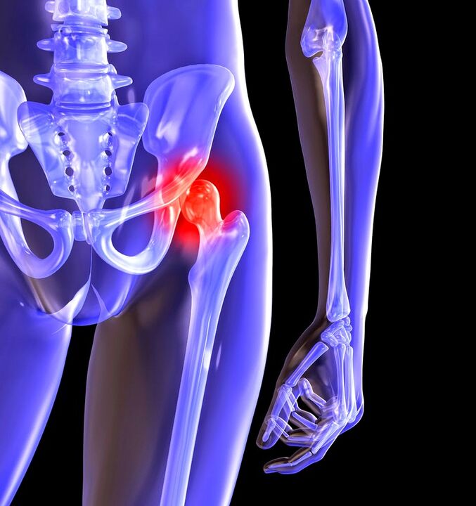Deform the arthrosis of the hip joint