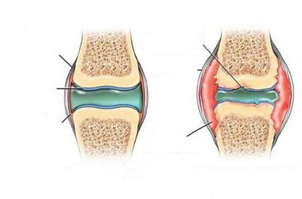 The process of deformation of the joint