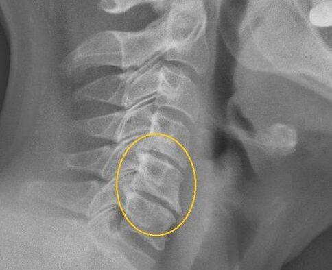 Osteochondrosis of the cervical column on a radius X