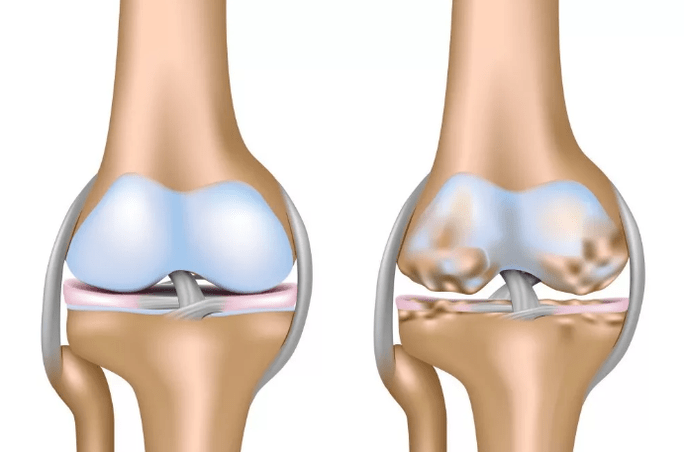 Deform the arthrosis of the knee joint