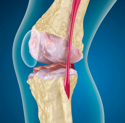 Red knee joint