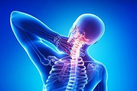 neck pain due to osteochondrosis