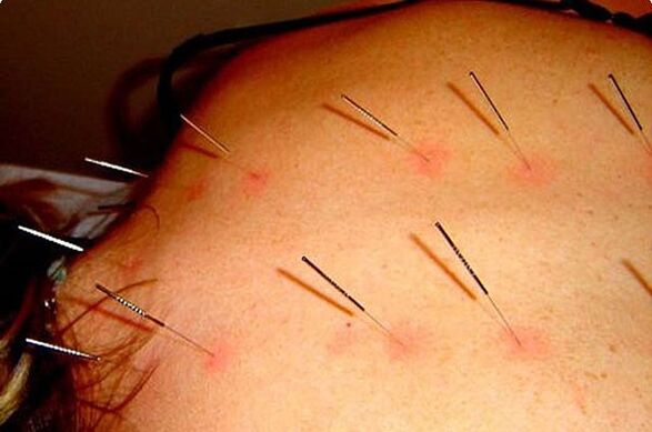 Acupuncture a method to treat cervical osteochondrosis